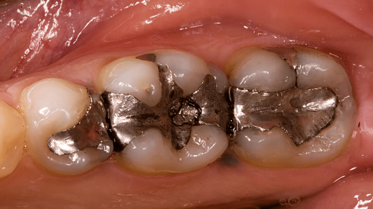 Amalgam | Elektrosensibilität
